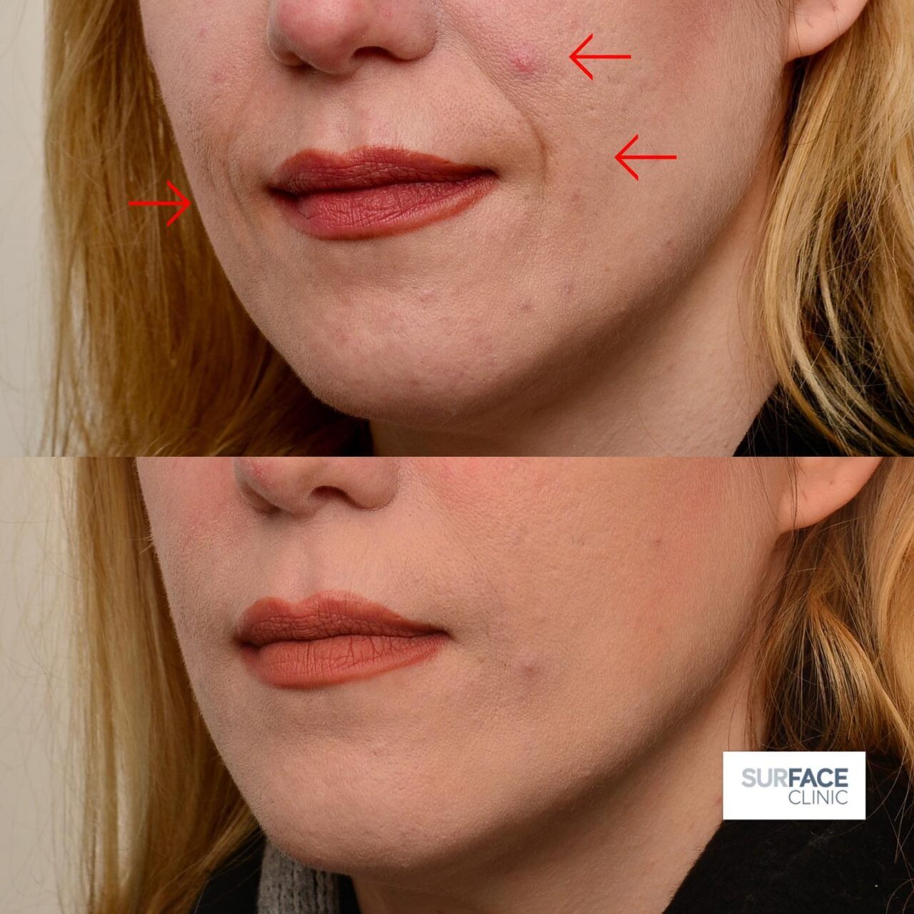 Dermal fillers Saltaire