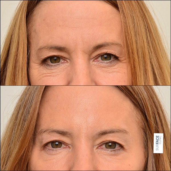 Forehead Filler Result