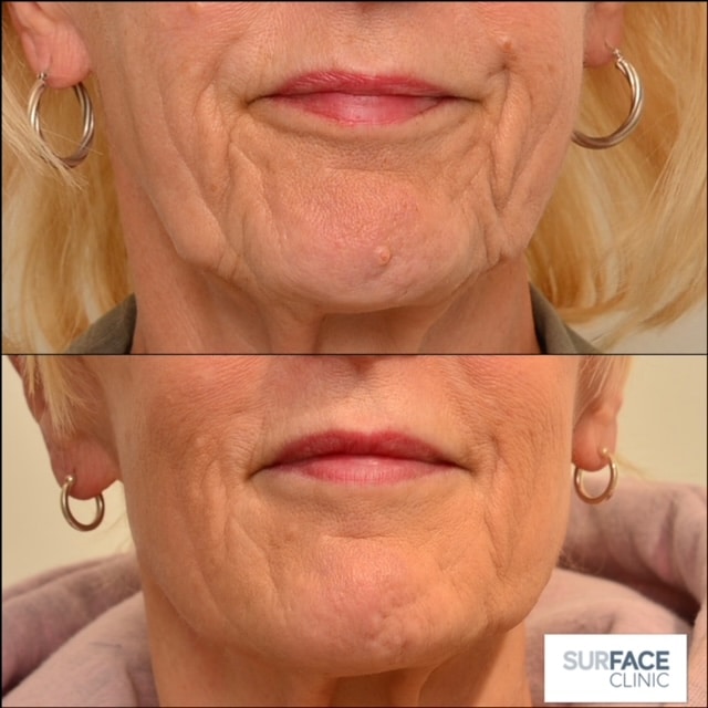 Nasolabial Folds, Marionette, Smile Lines Result