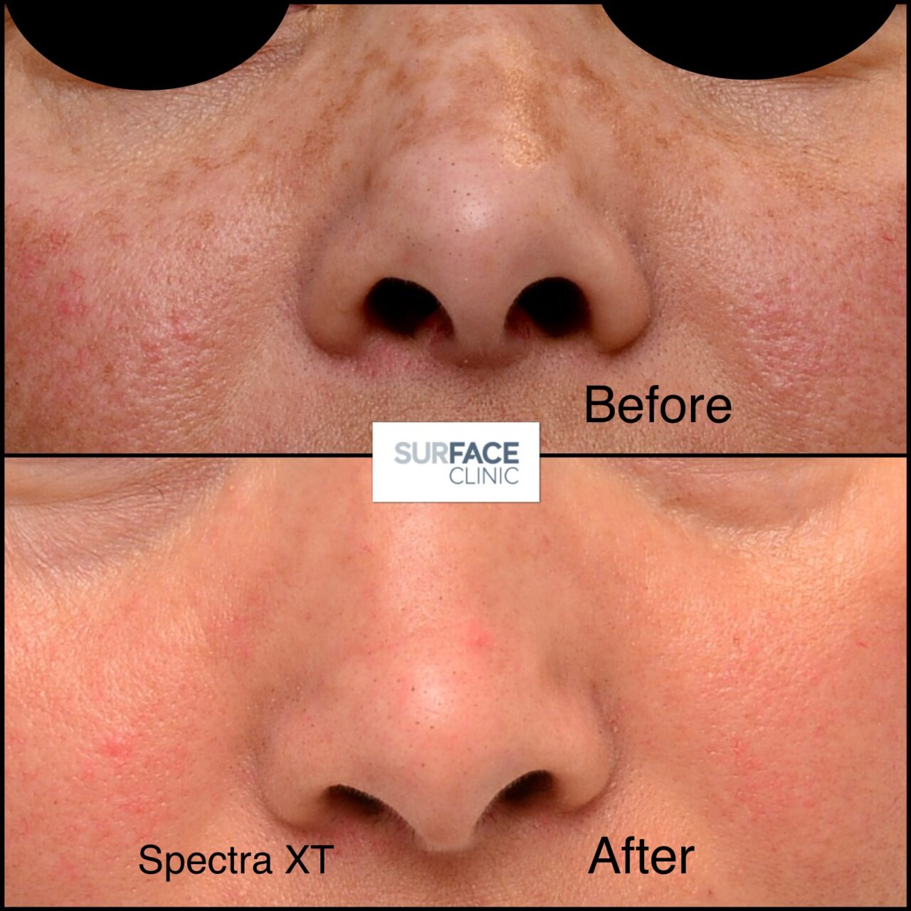 Skin rejuvenation