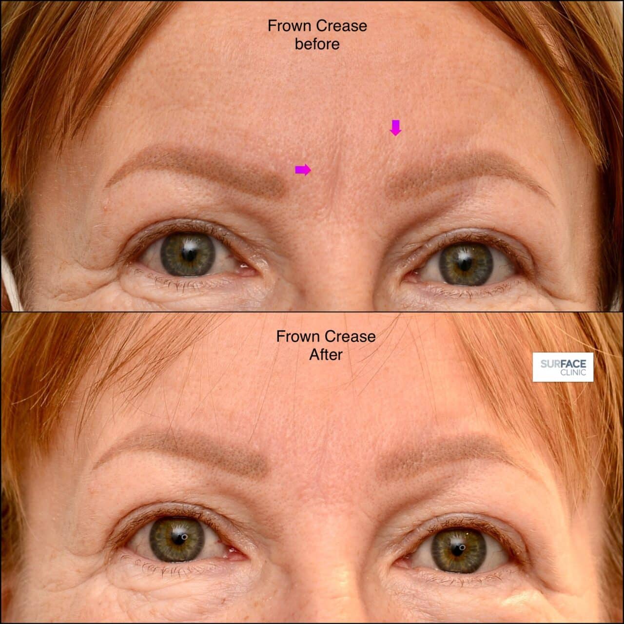 Dermal fillers Bradford