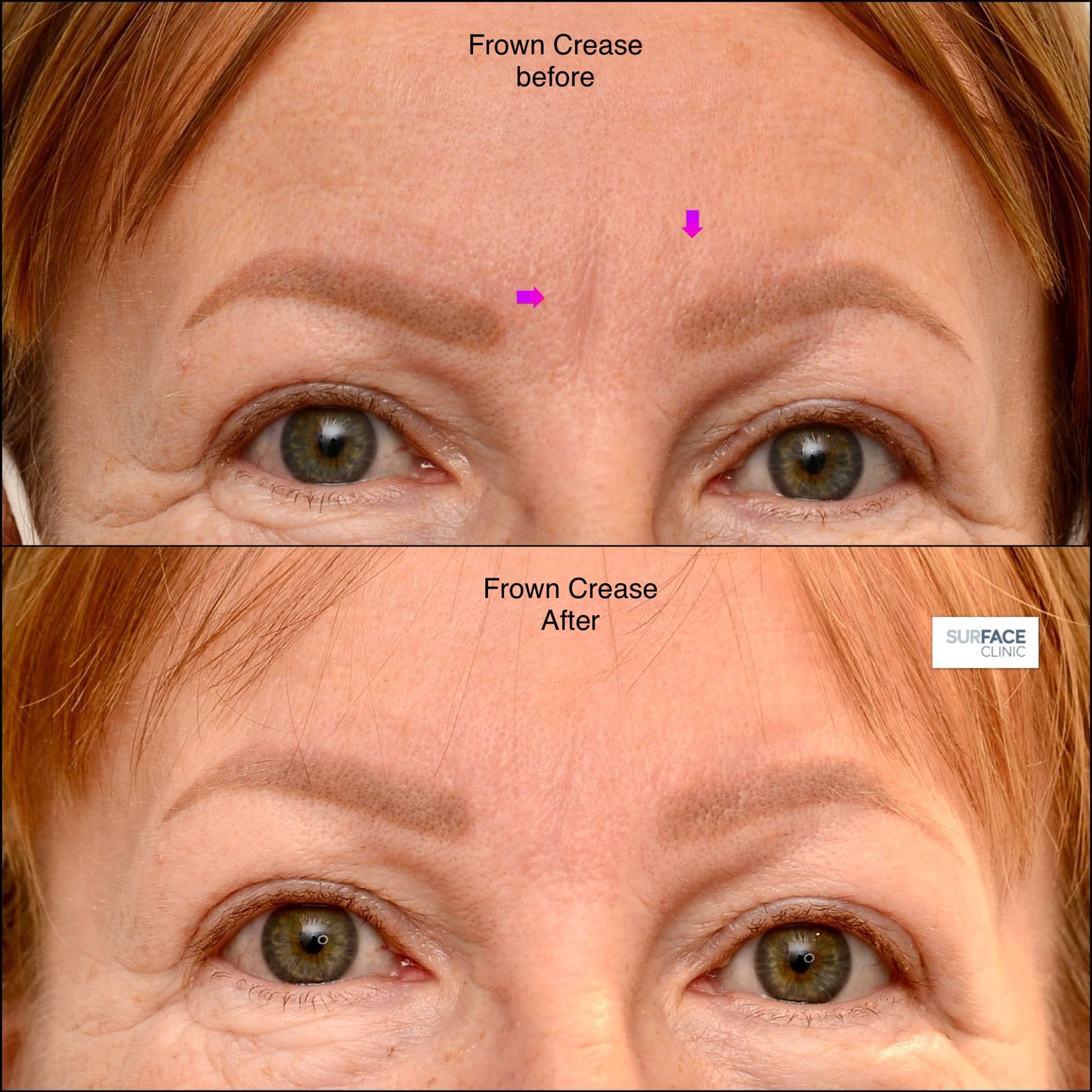 Glabella Frown Lines Result