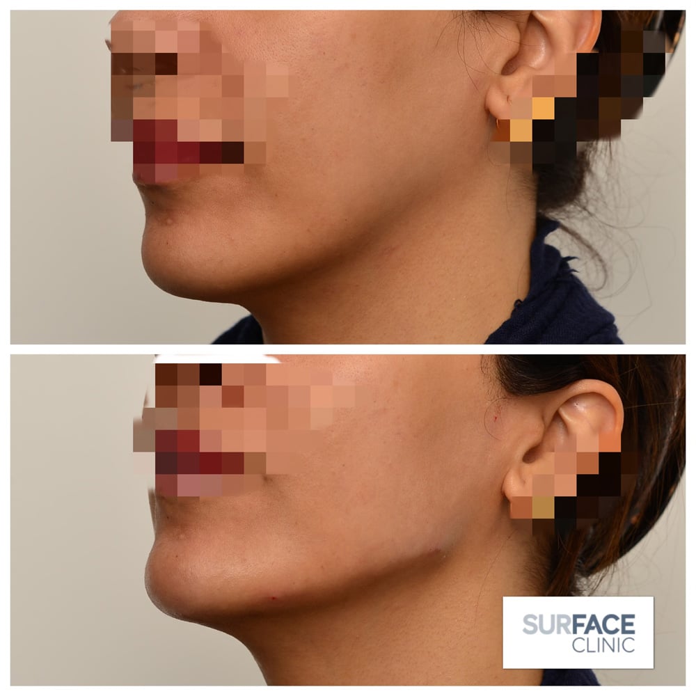 Jawline Correction Result