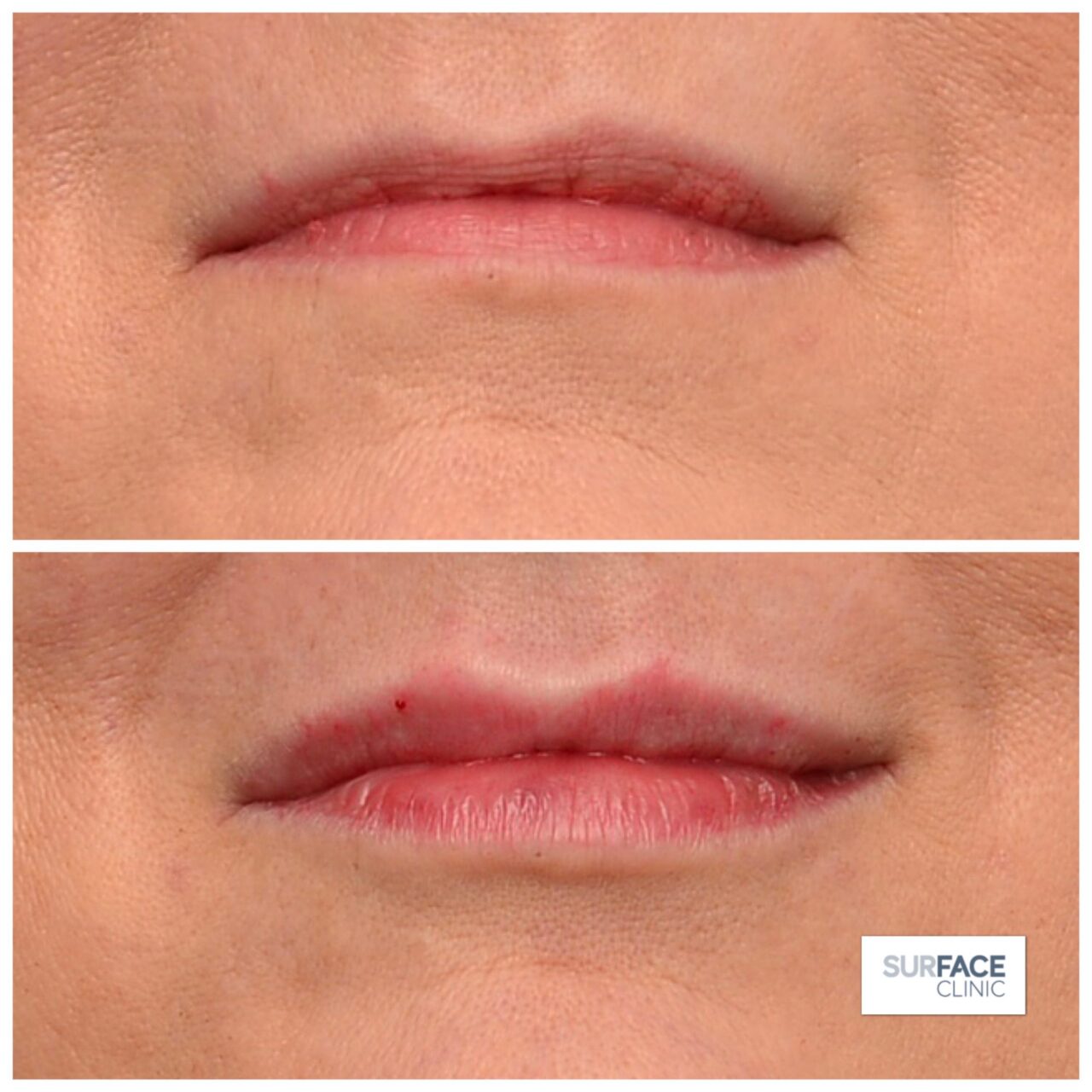 Lip Filler