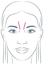 Glabella Frown Lines