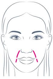 Nasolabial Folds, Marionette, Smile Lines