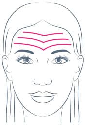 Forehead Filler