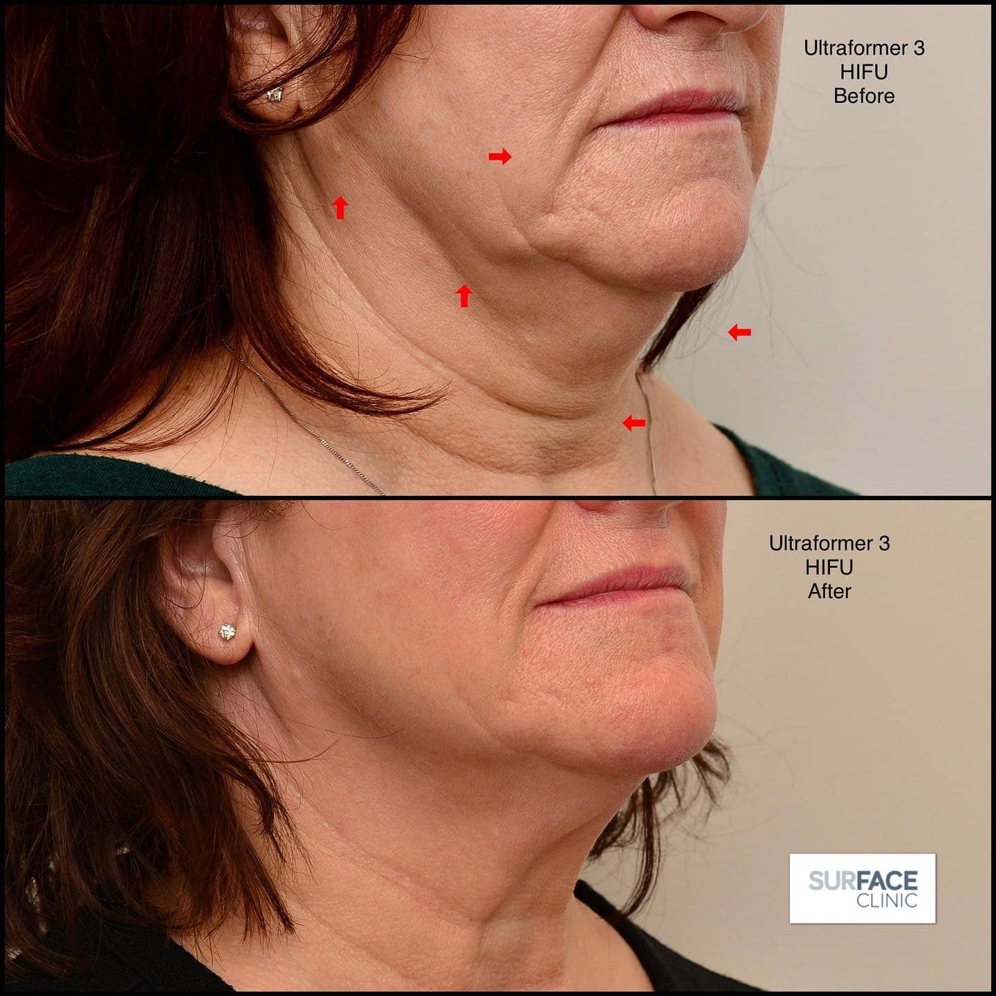 Anti-Ageing Result