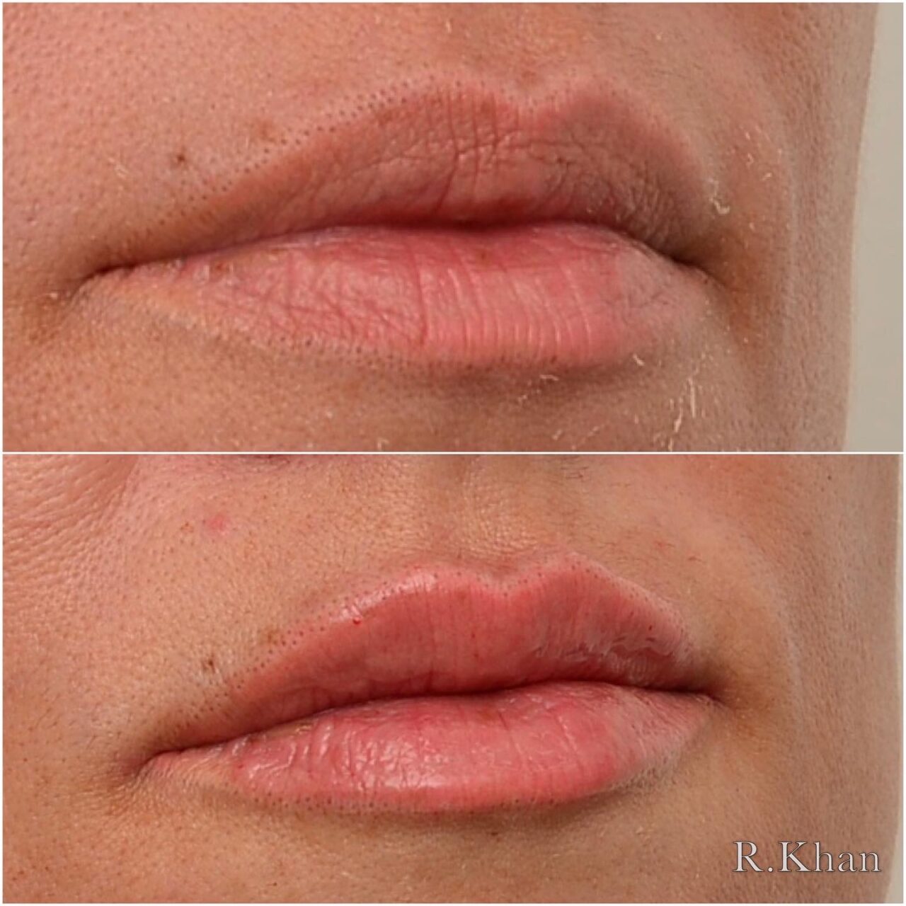 Lip filler Bingley