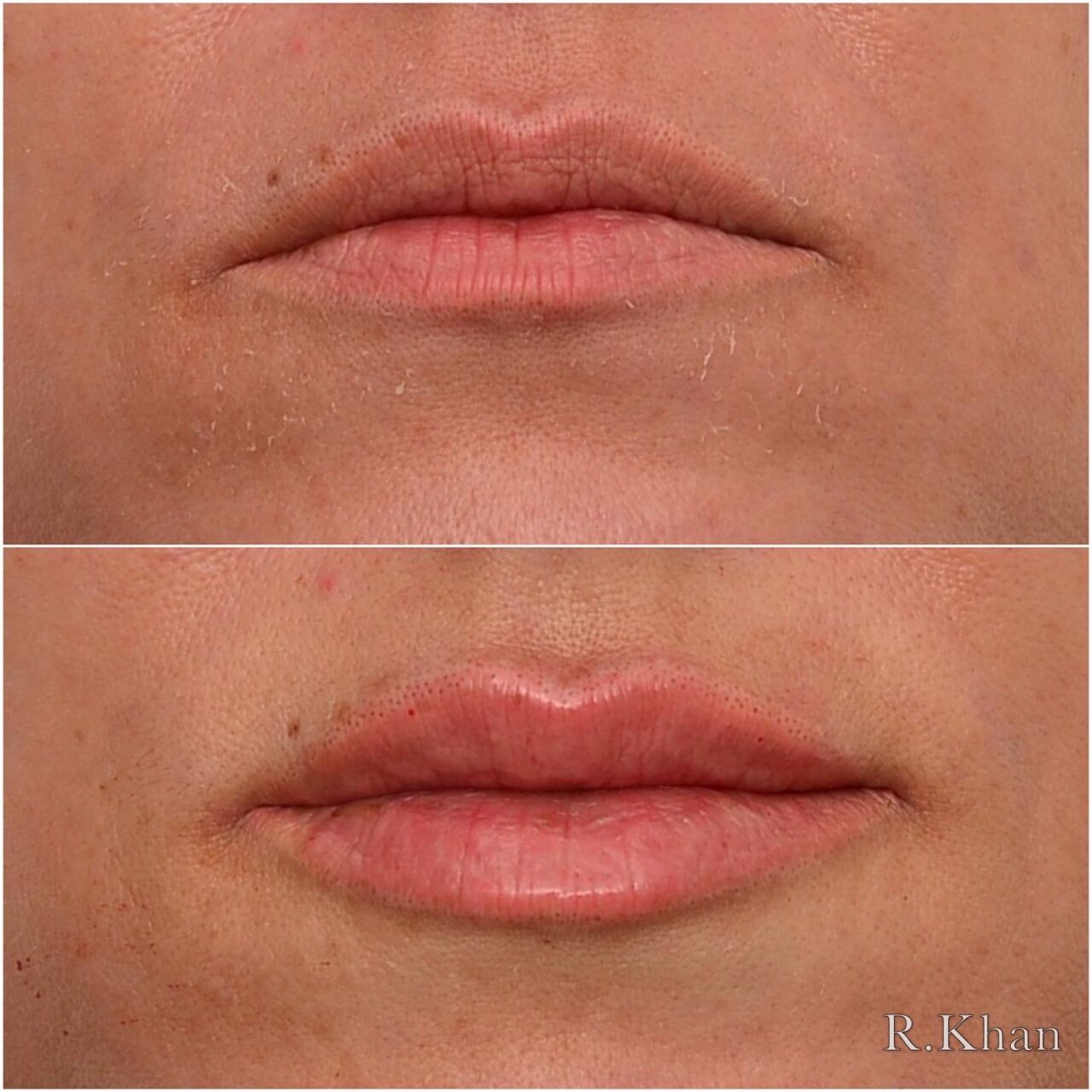 Lip filler Bingley