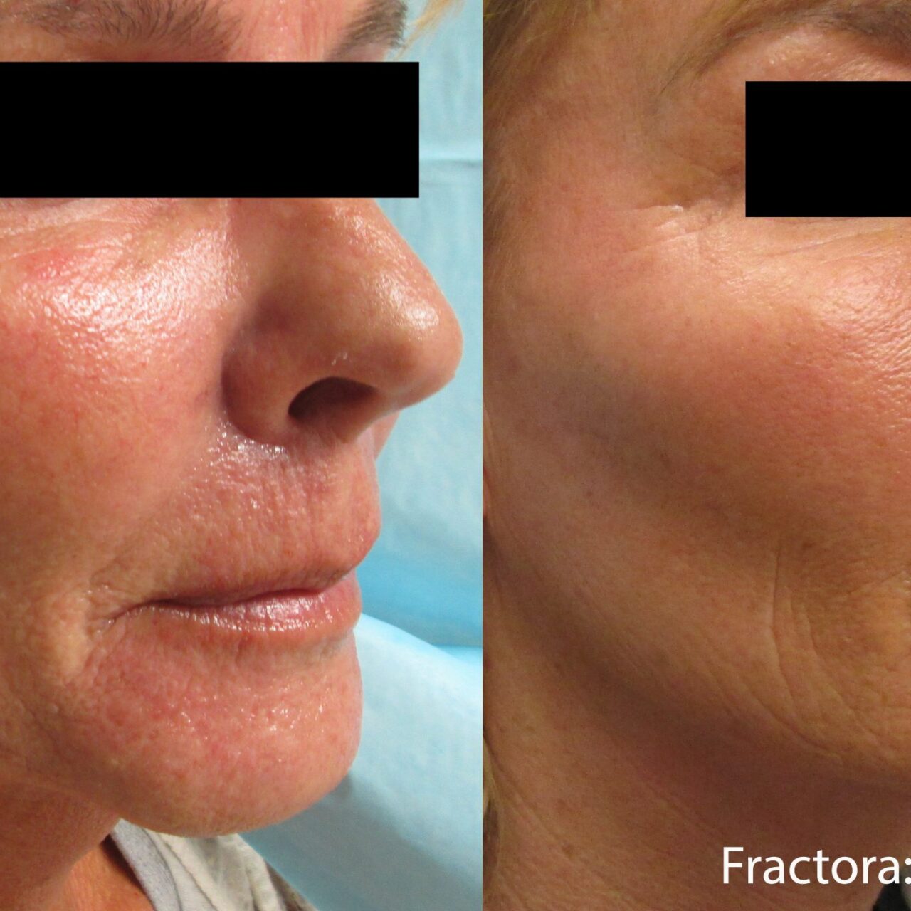 Inmode Fractora