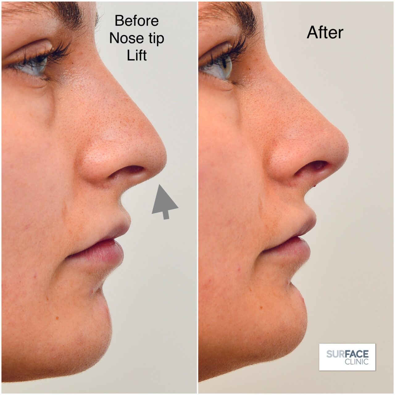 Non-surgical rhinoplasty Bradford