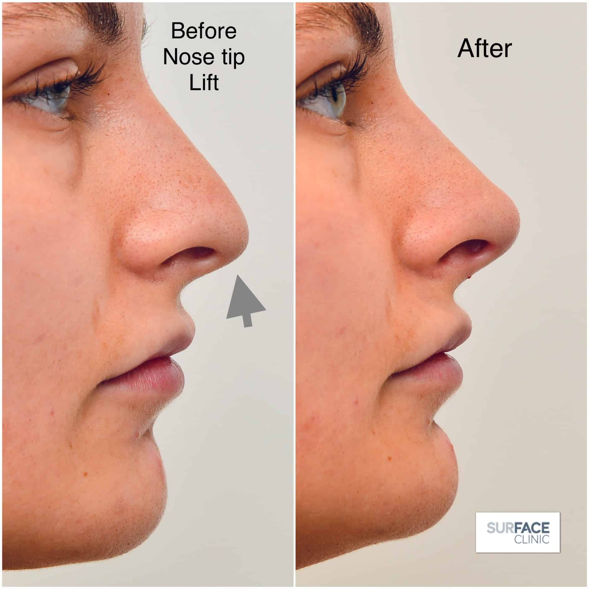 Non-Surgical Nose Shaping Result