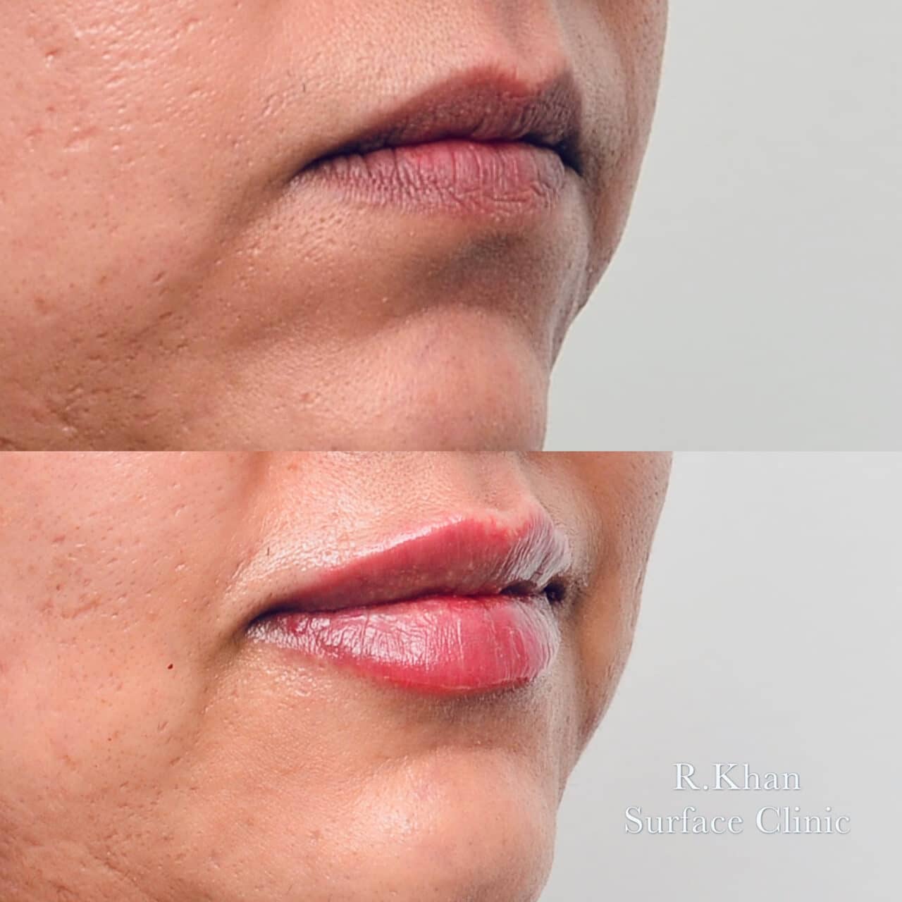 Lip filler Shipley