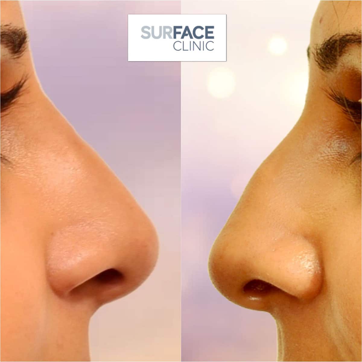 Non-Surgical Nose Shaping Result
