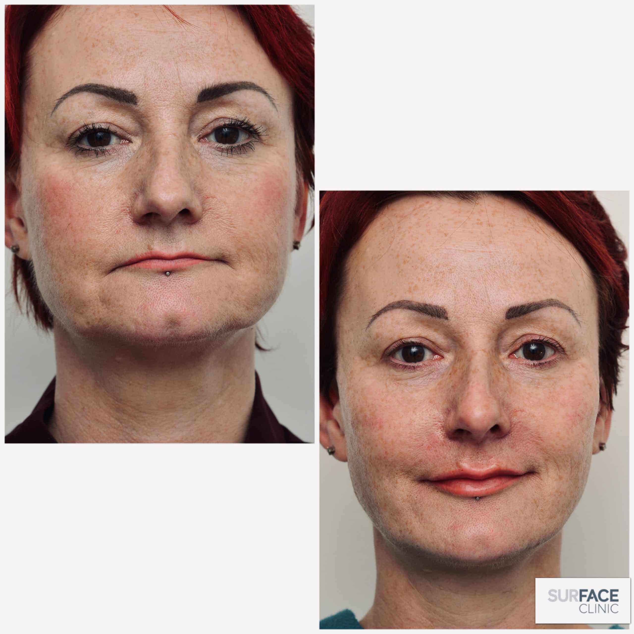 3D Cheek Lift & Volumise Result