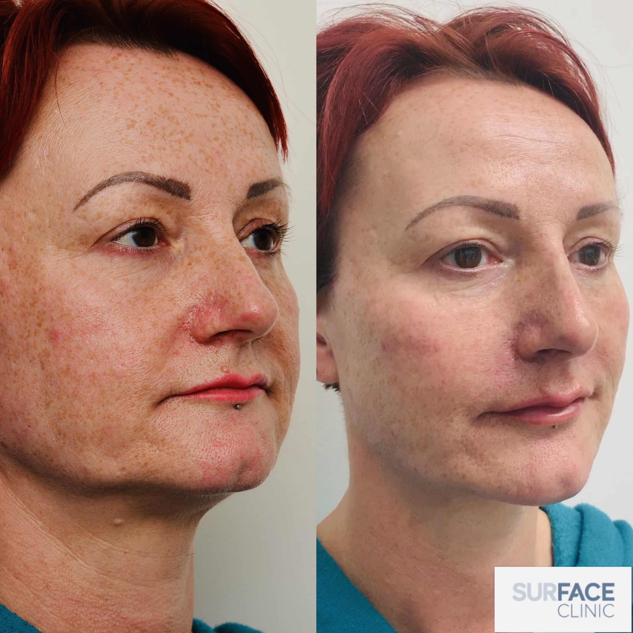 3D Cheek Lift & Volumise Result