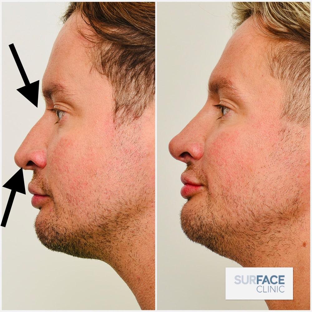 Nose Enhancements Result