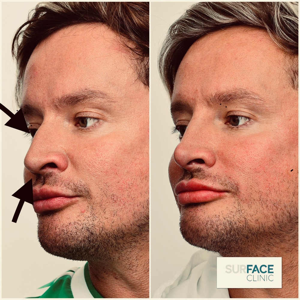 Non-Surgical Nose Shaping Result