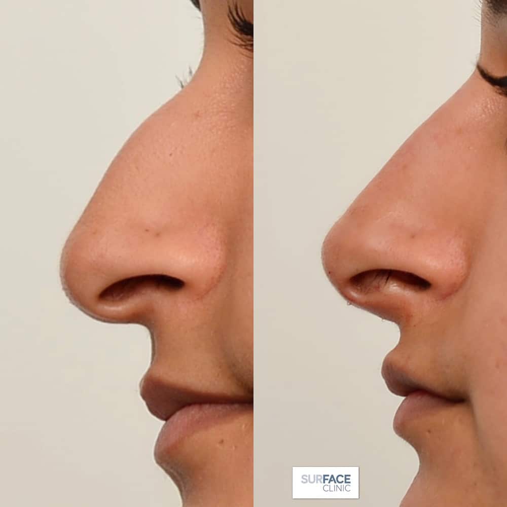 Non-Surgical Nose Shaping Result