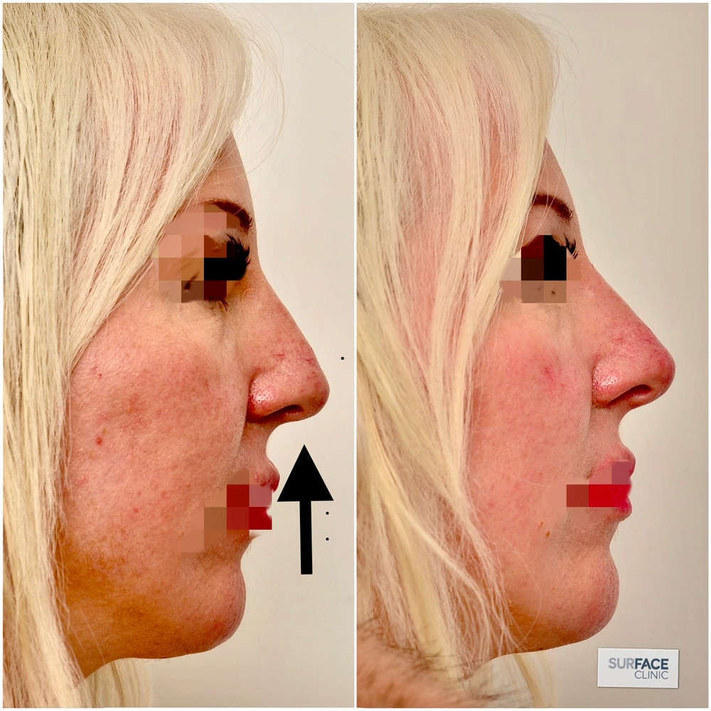Volume Loss, Shape & Countour Result