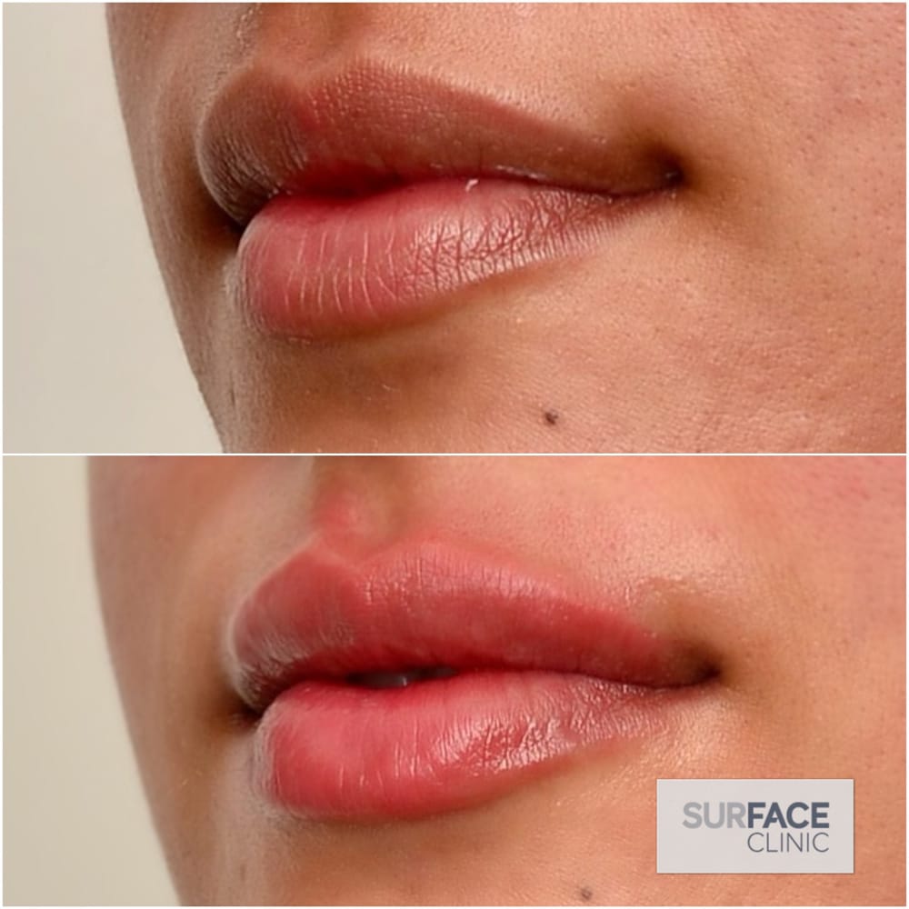 Lip Filler Result