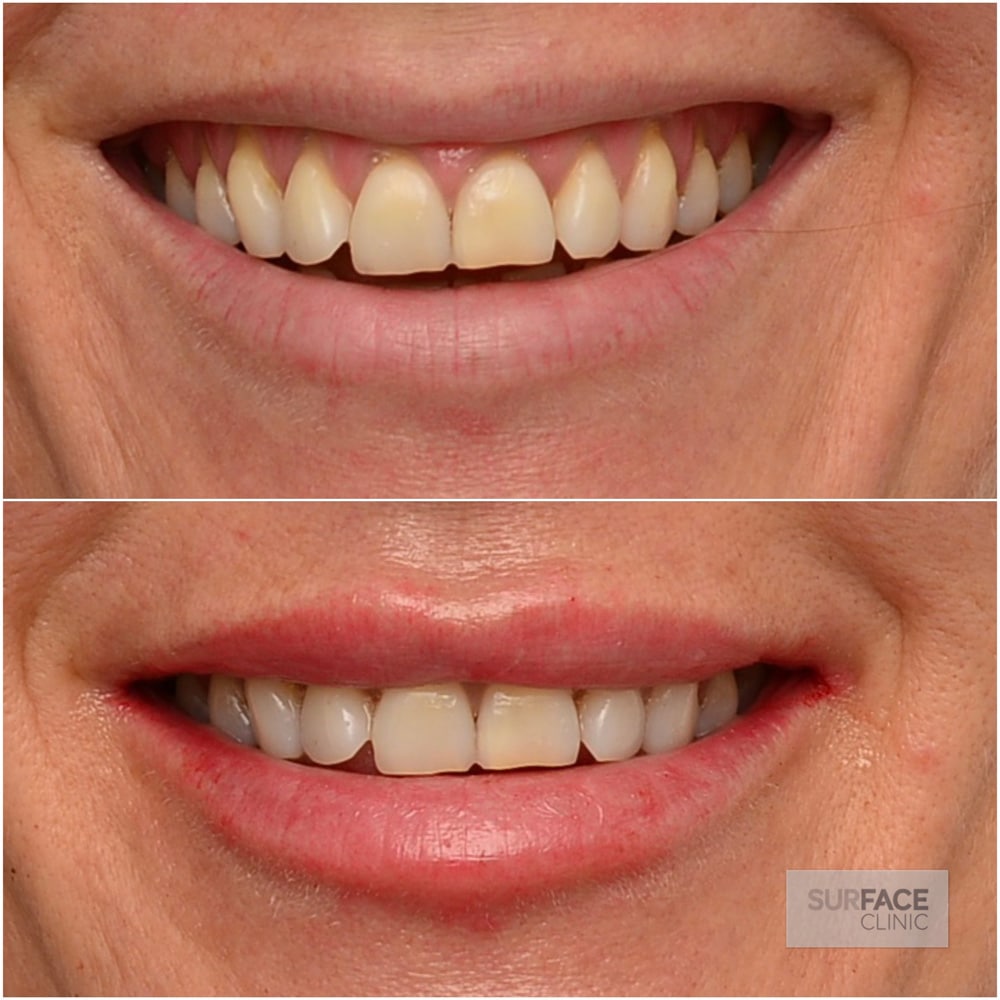 Lips Result