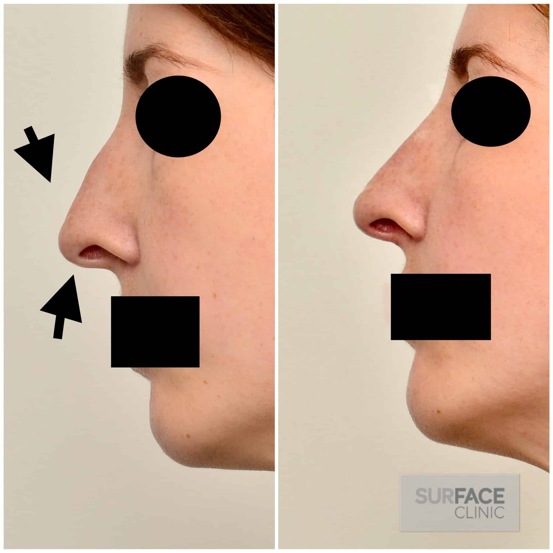 Non-Surgical Nose Shaping Result