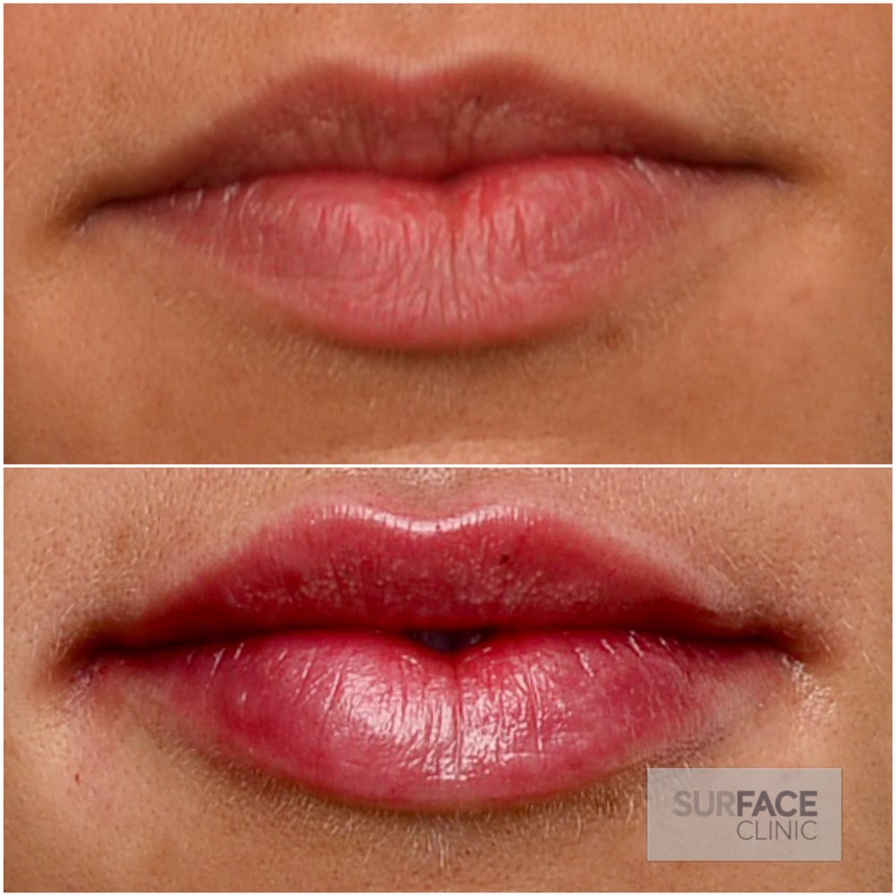 Lip Filler Result