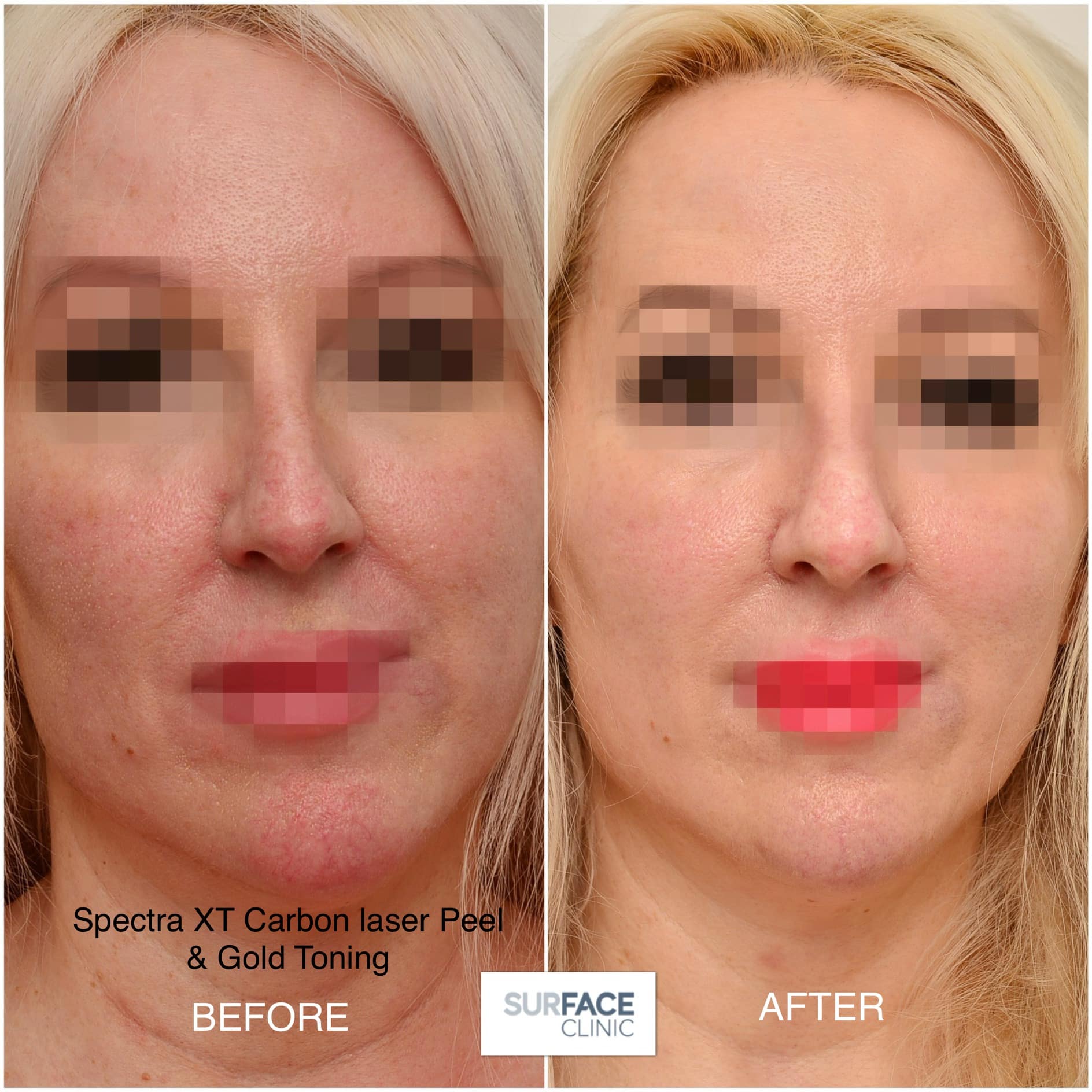 3D Cheek Lift & Volumise Result