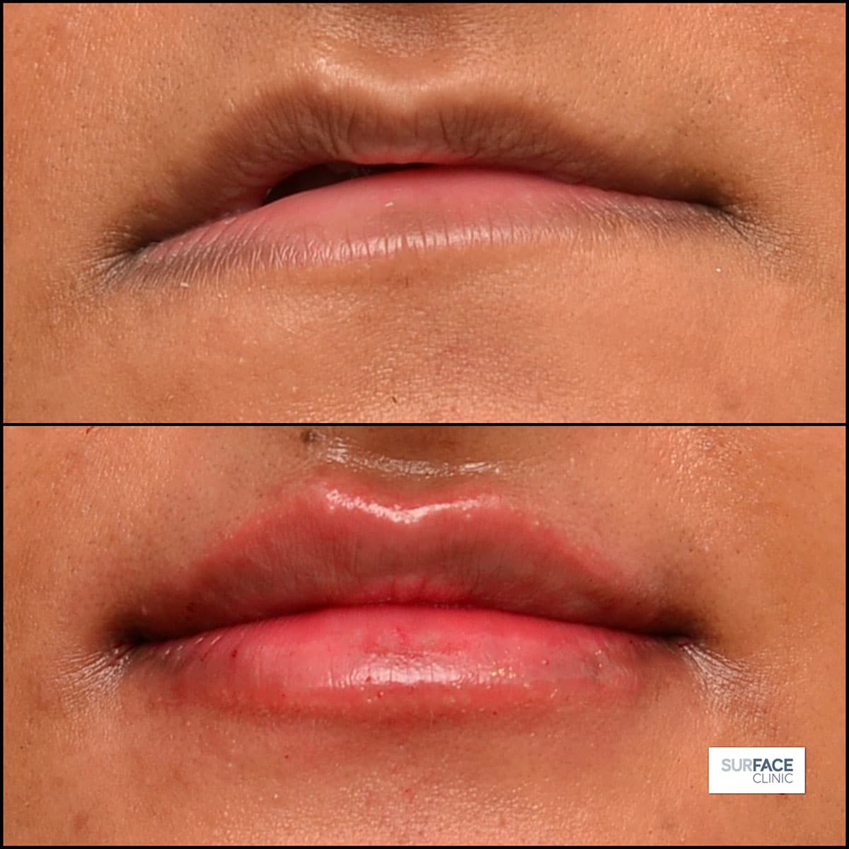 Non-Surgical Nose Shaping Result