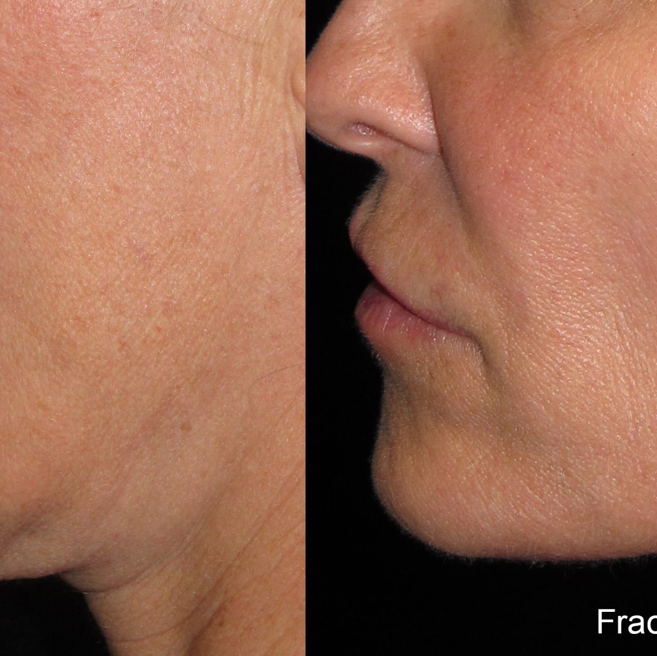 Inmode skin tightening
