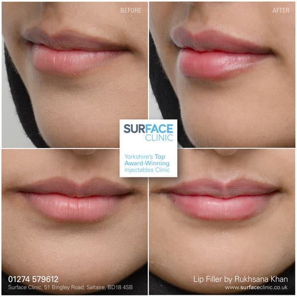 Lip Filler Result