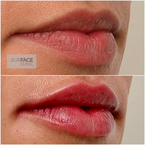 Lip Filler Result