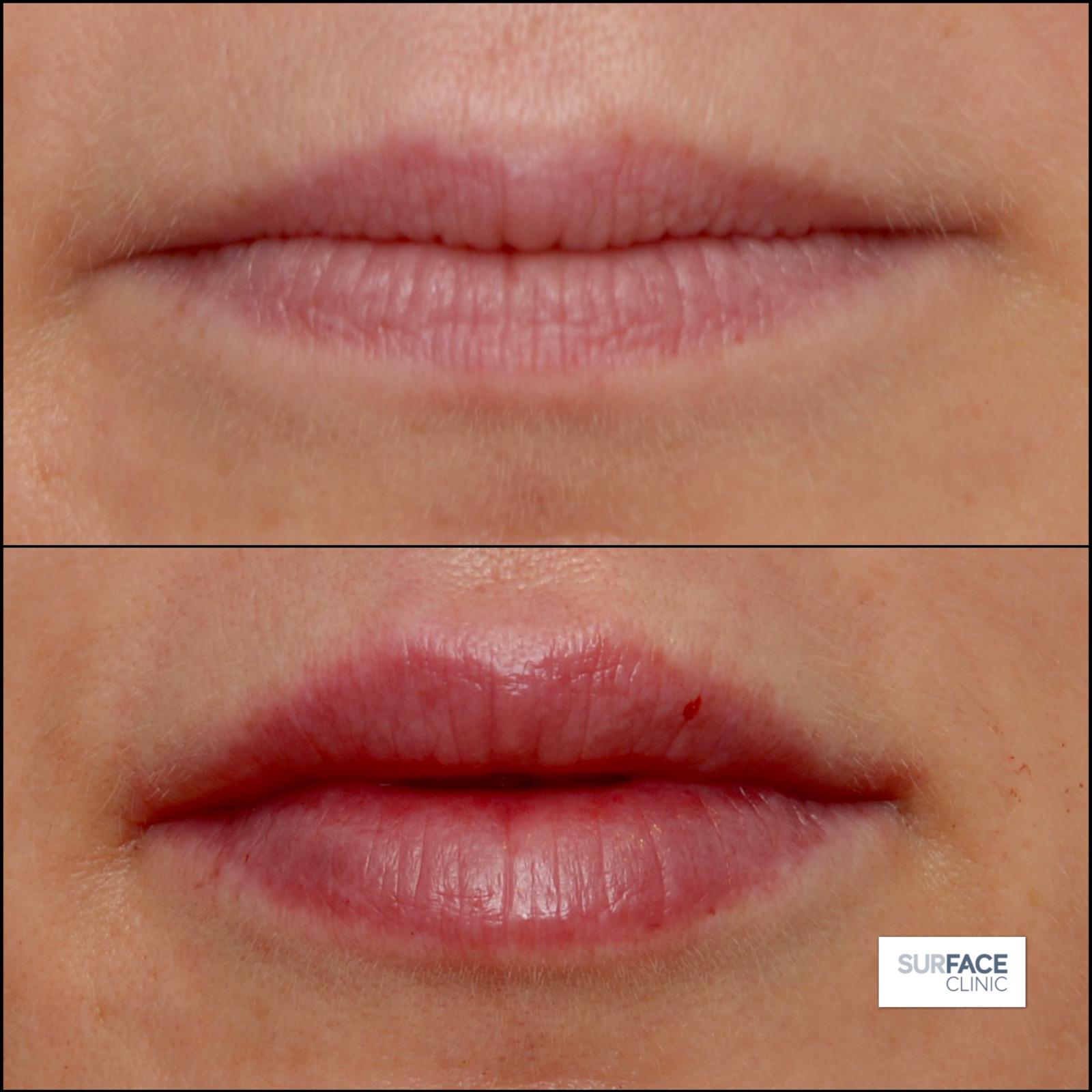 Lips Result