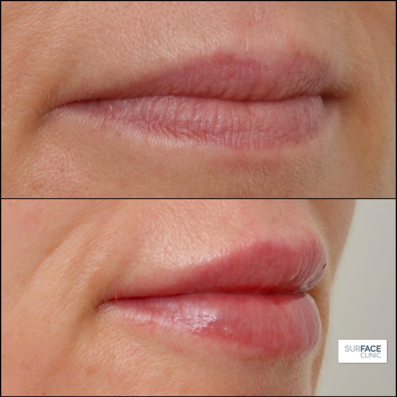 Lip Filler bradford