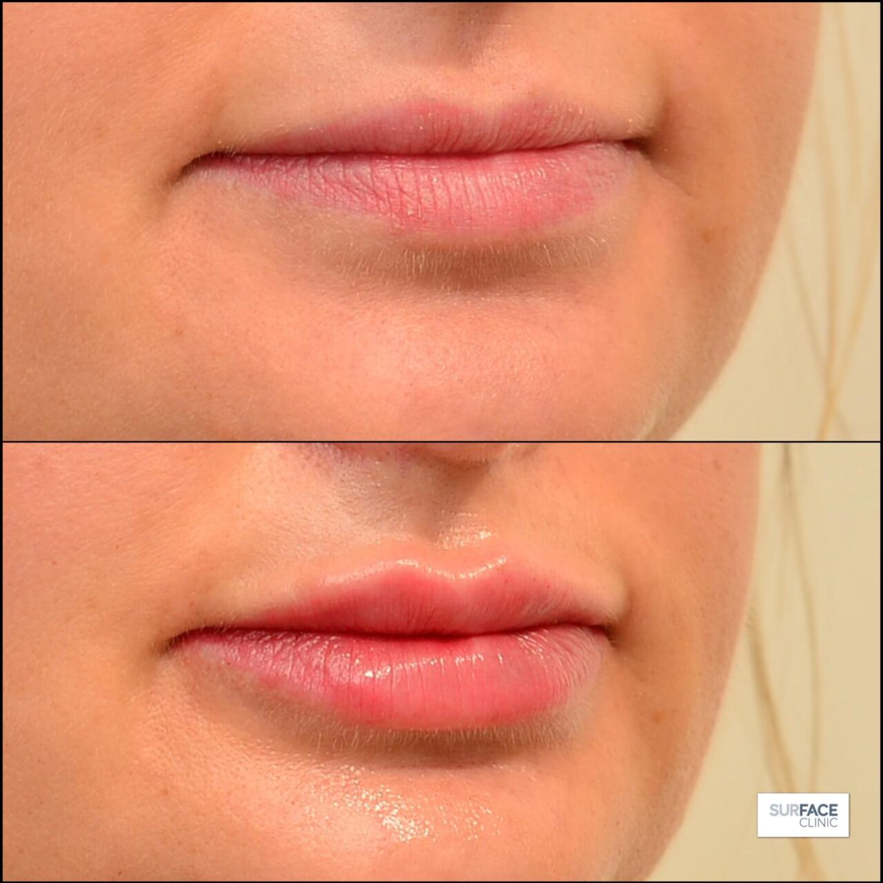 Lip Filler bradford