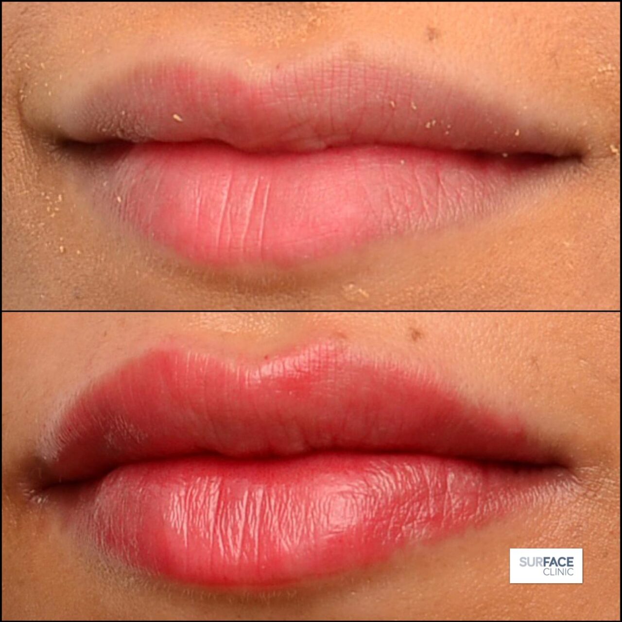 Lip Filler