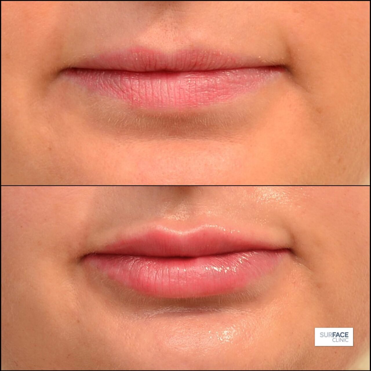 Lip Filler