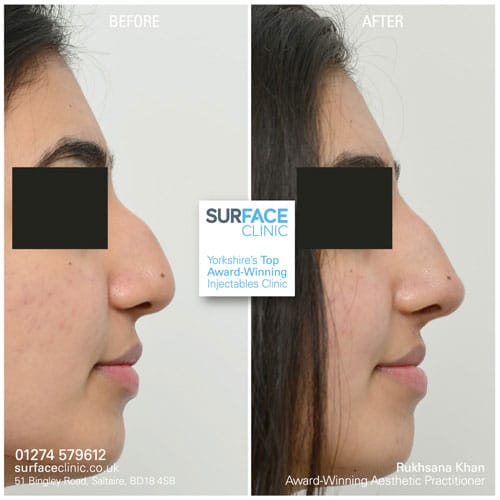 Non-Surgical Nose Shaping Result