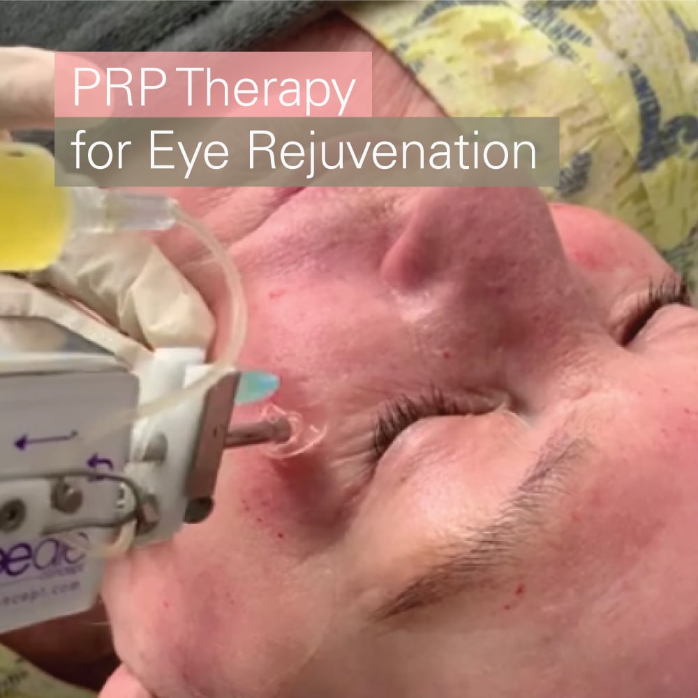 PRP therapy