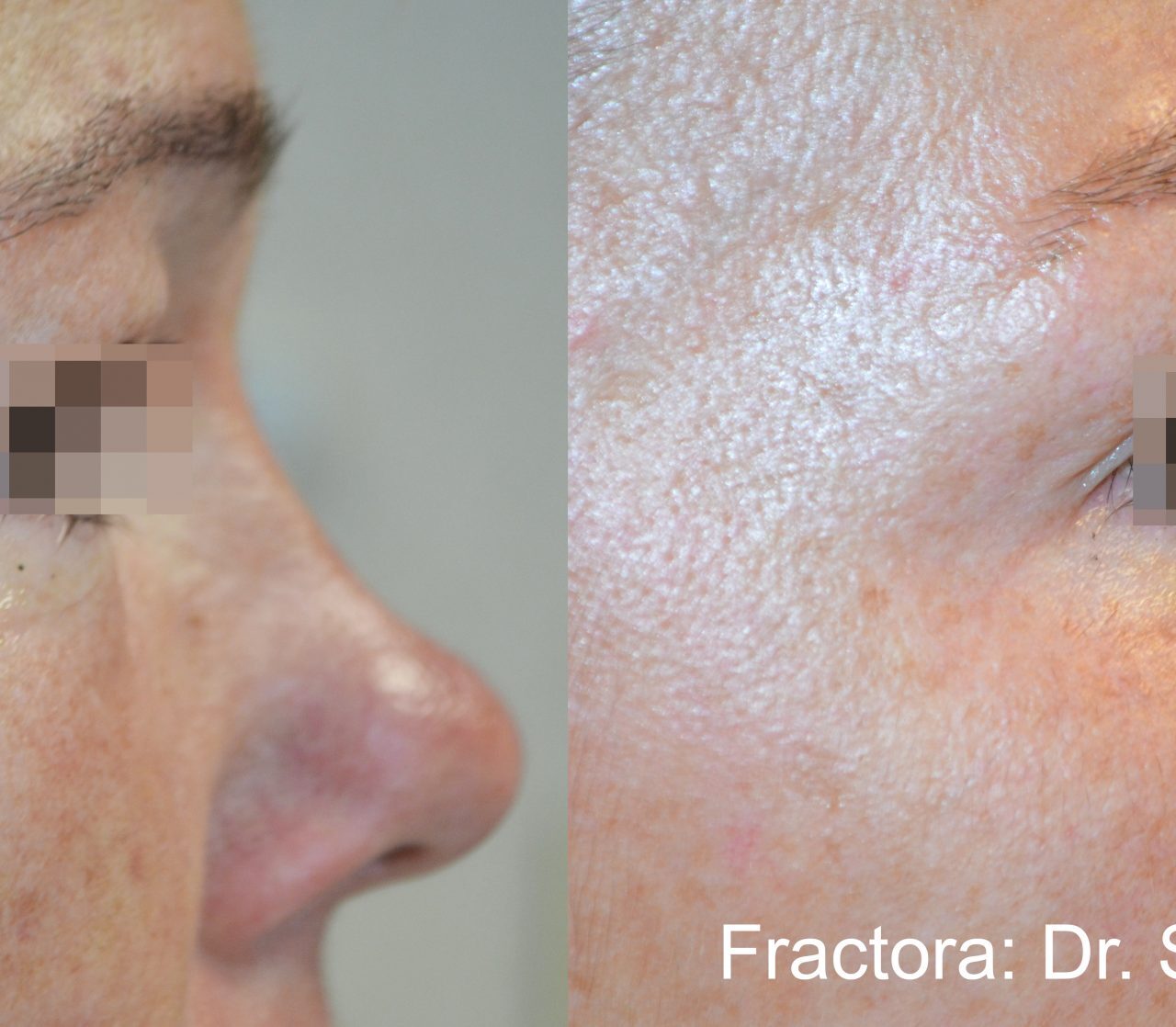 Inmode skin rejuvenation