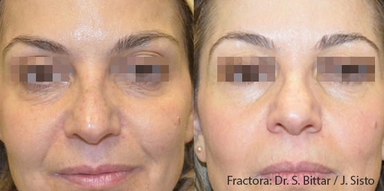 Inmode skin rejuvenation