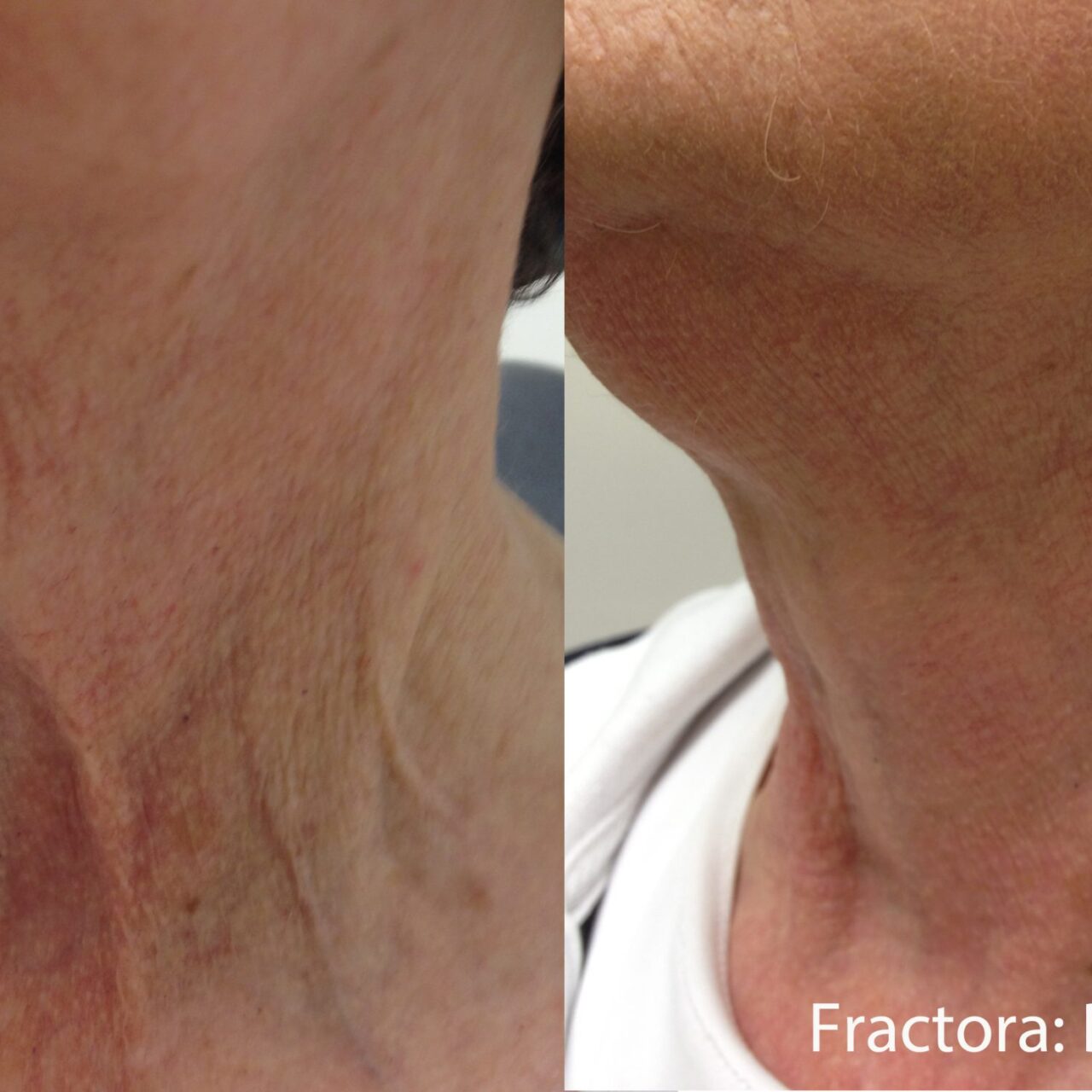 Inmode Fractora