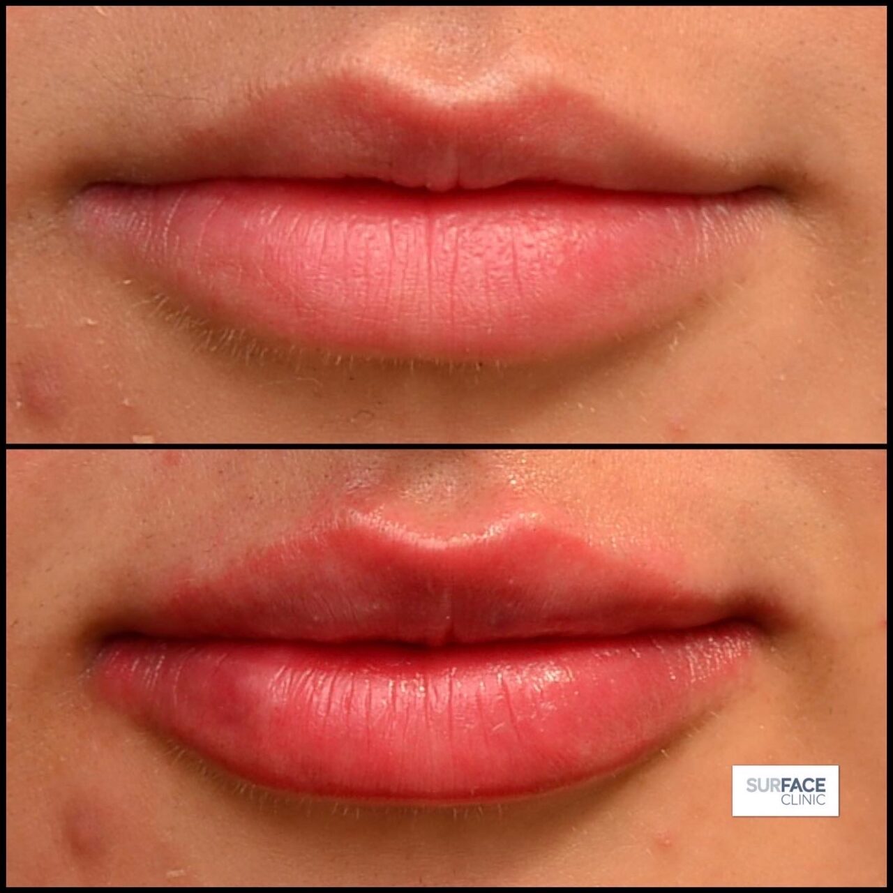 Lip filler Bingley