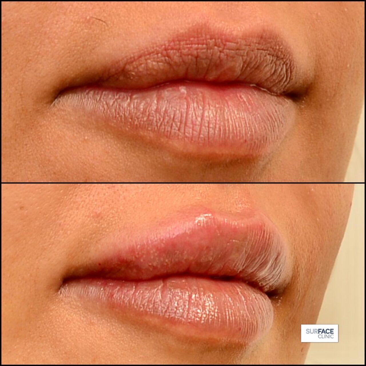 Lip filler Ilkley
