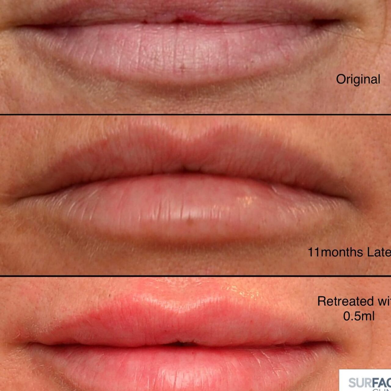 Lip filler Ilkley