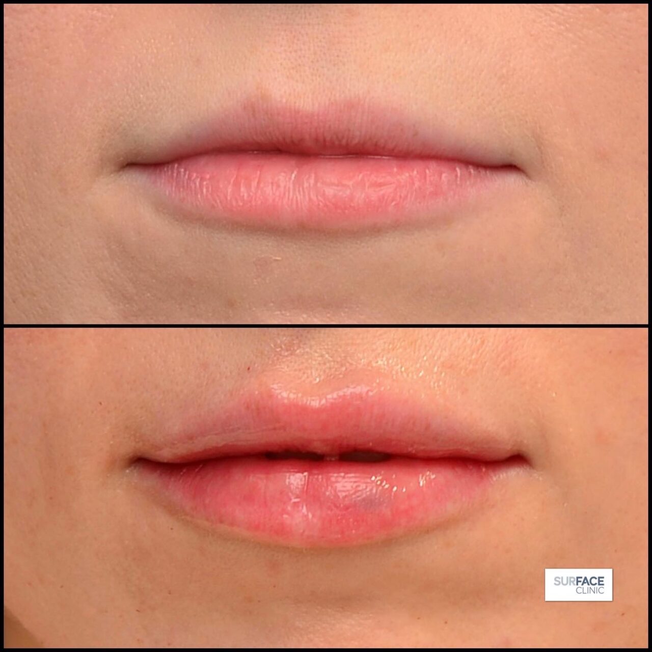 Lip filler Ilkley