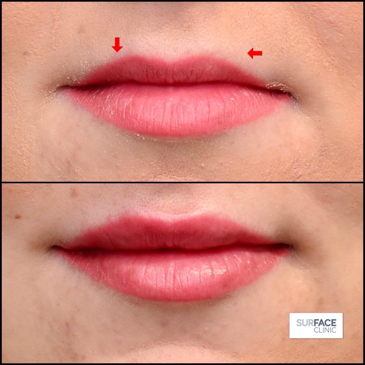 Lip filler Bradford