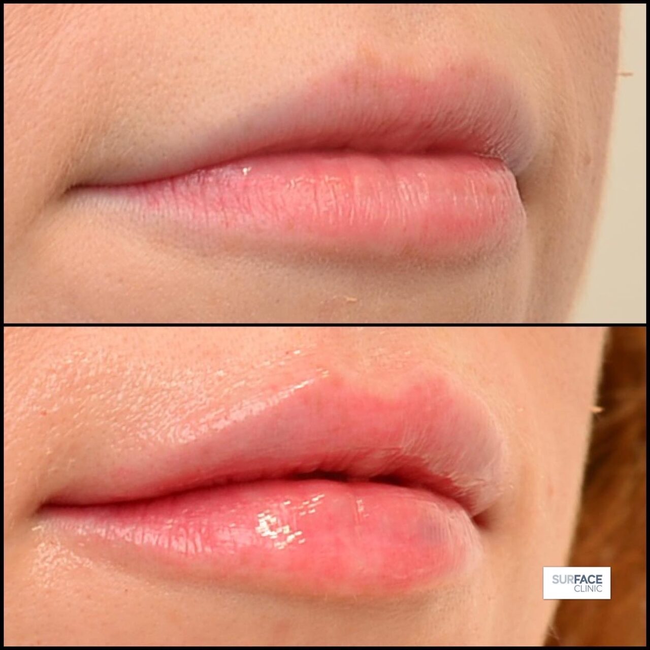 Lip filler Saltaire